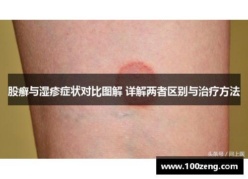 股癣与湿疹症状对比图解 详解两者区别与治疗方法